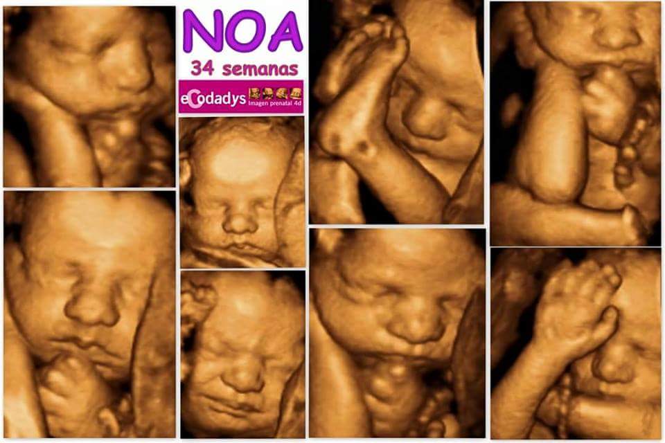 Bebé de 34 semanas llamado Noa