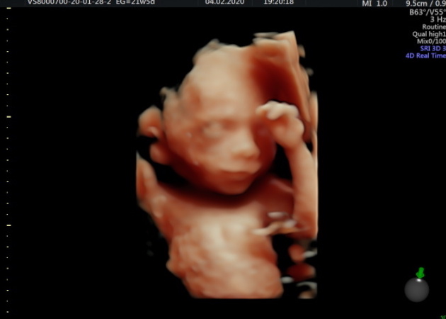 Ecografía de bebé de 21 semanas de ombligo a cabeza