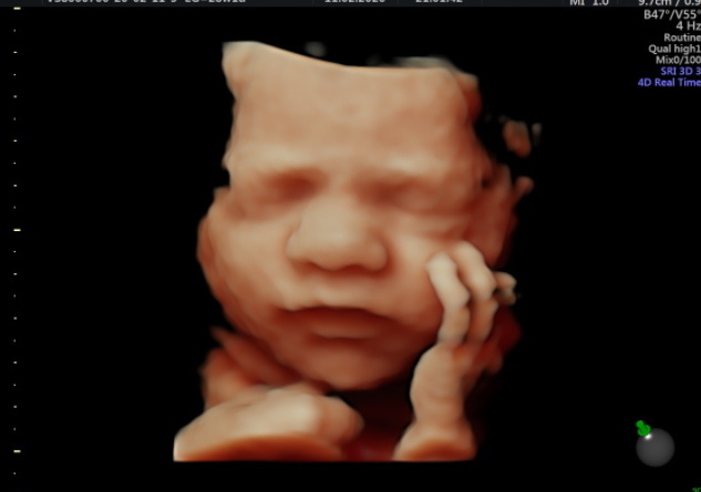 Bebé de 28 semanas con la mano en la mejilla